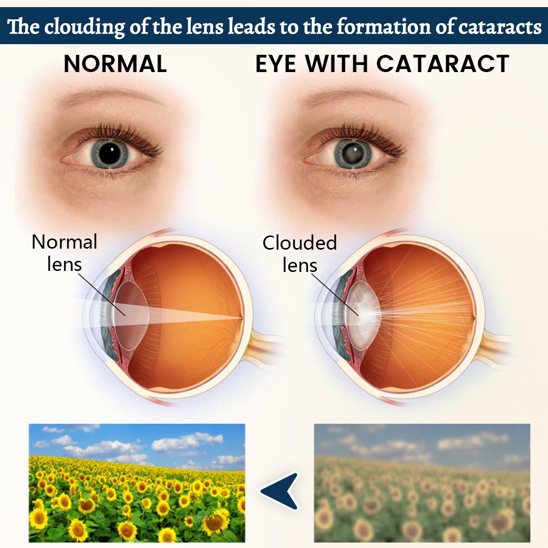 ERYVONS® OptiSynera Vision Support Eye Patch👁️✨